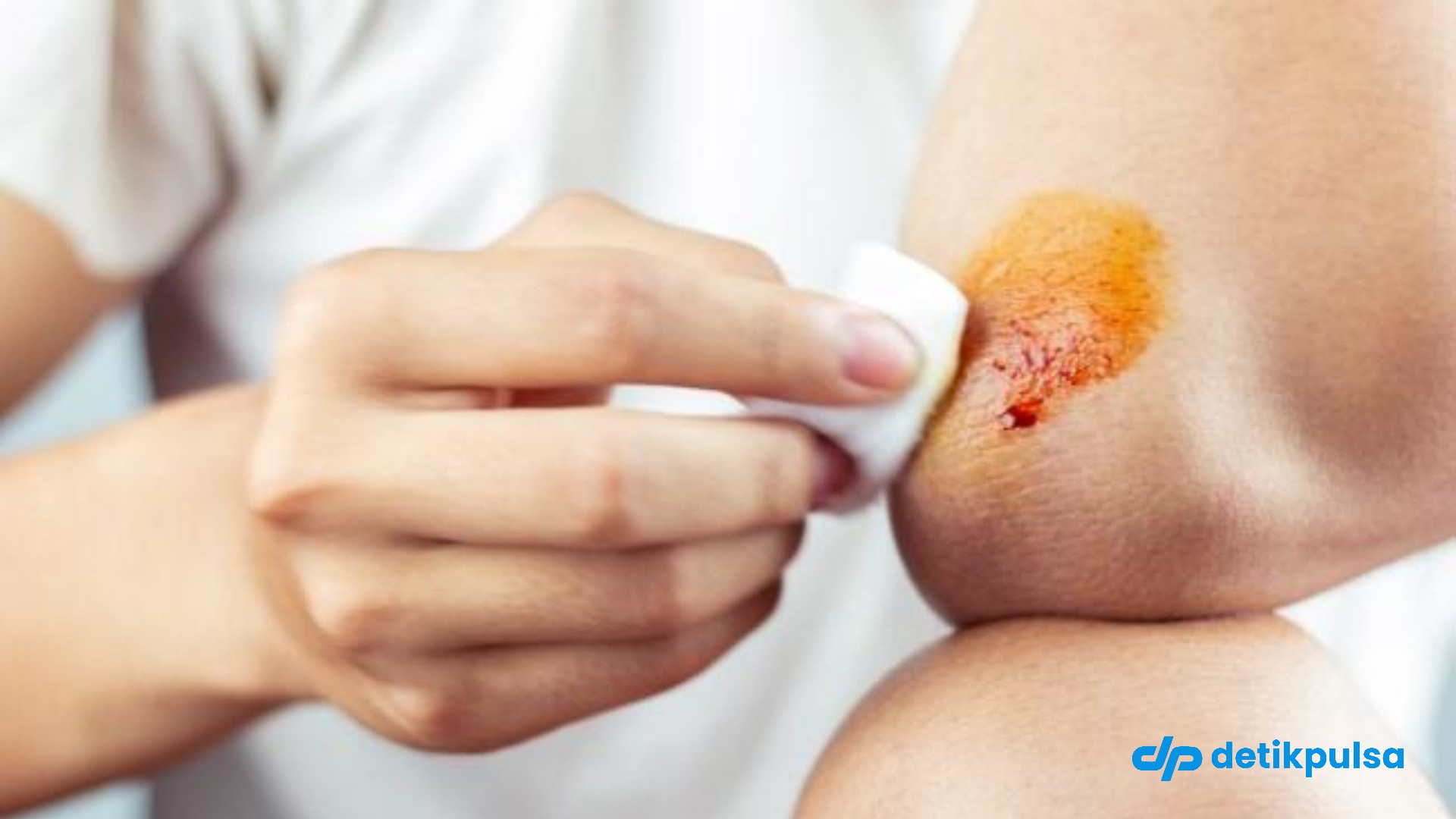 7 Tips Obati Luka Berair agar Cepat Kering