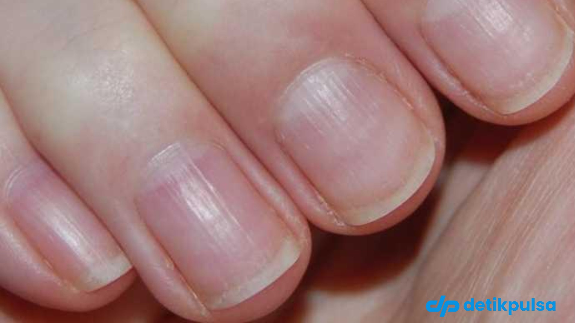 6 Tips Cegah Kuku Bergelombang